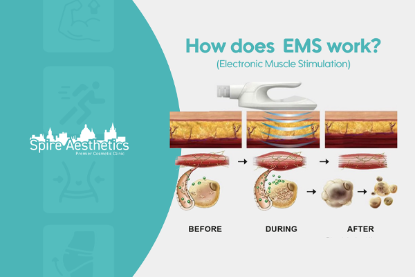 EMS treatment for post pregnancy weight loss treatment Sheffield