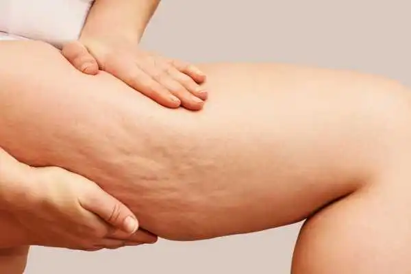Image of woman showing leg with cellulite Sheffield