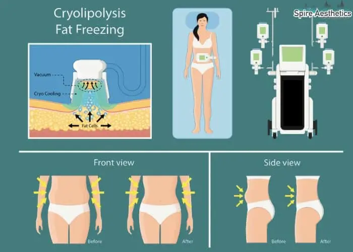 Fat freezing treatment Sheffield benefits for competitions to remove stubborn fat deposits.