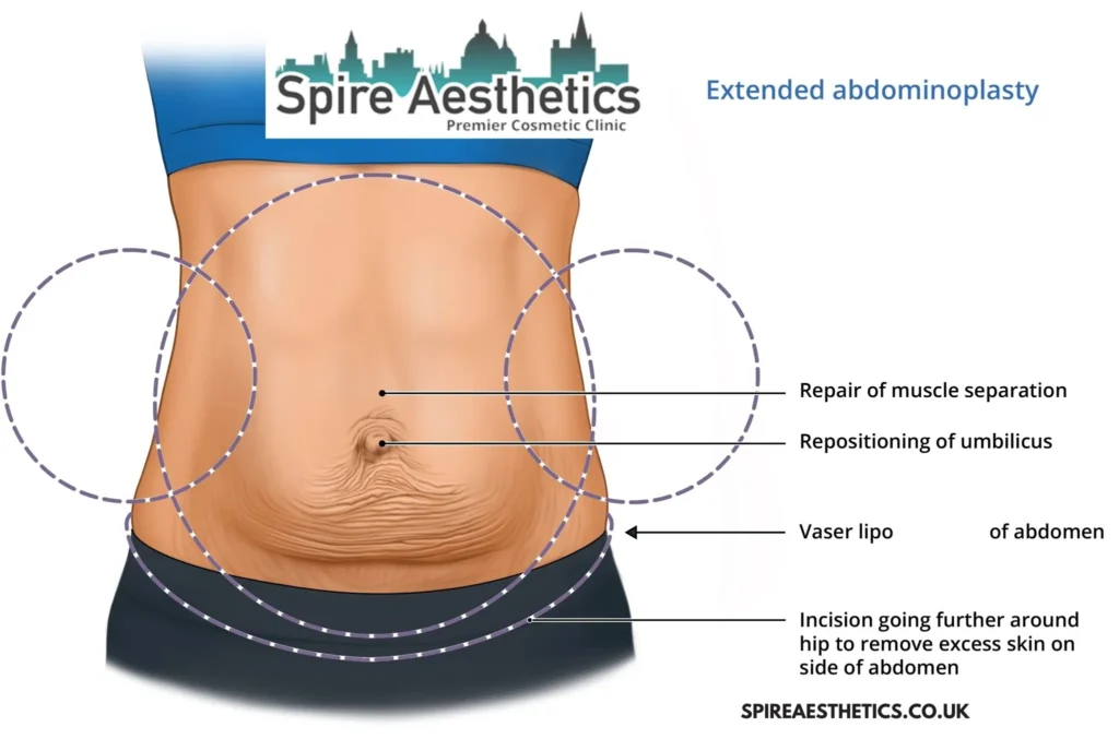 Understanding Loose Skin After Gastric Band Sheffield Surgery and HIFU Treatment