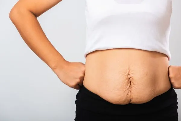 Image of a woman's stomach after weight loss with sagging skin following a gastric band Sheffield