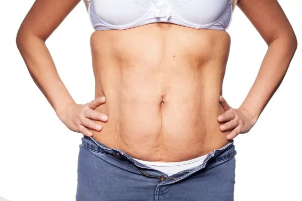 sagging skin on woman's stomach after weight loss injections Sheffield