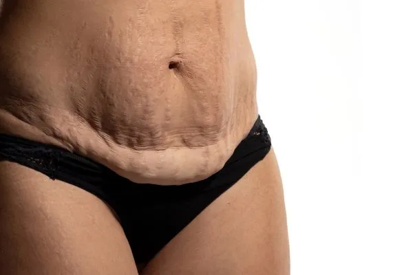 Image of womans stomach after weight loss injections Sheffield showing saggy skin