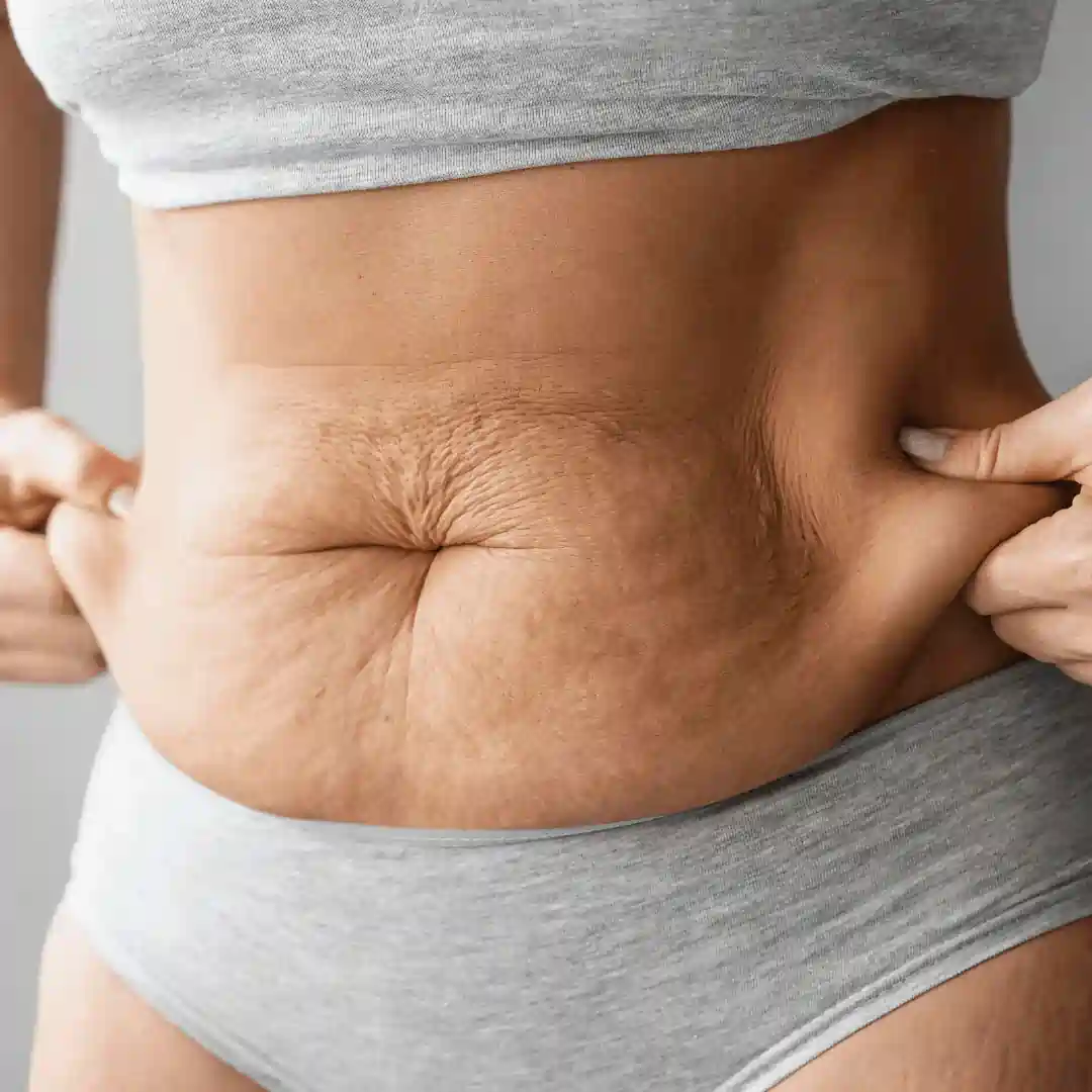 Is It Normal to Have Loose Skin After Pregnancy Sheffield?