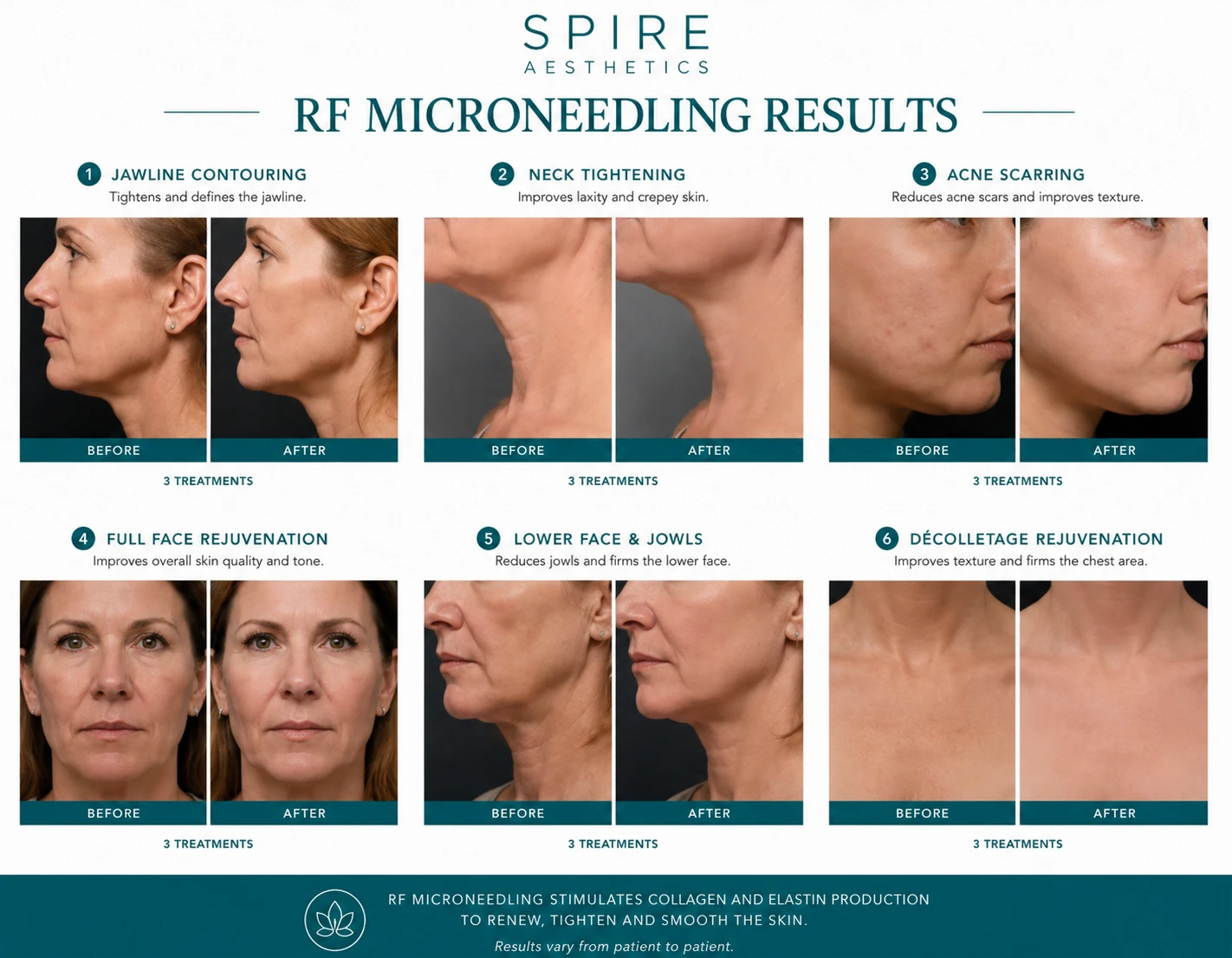 RF Microneedling Skin tightening Sheffield results