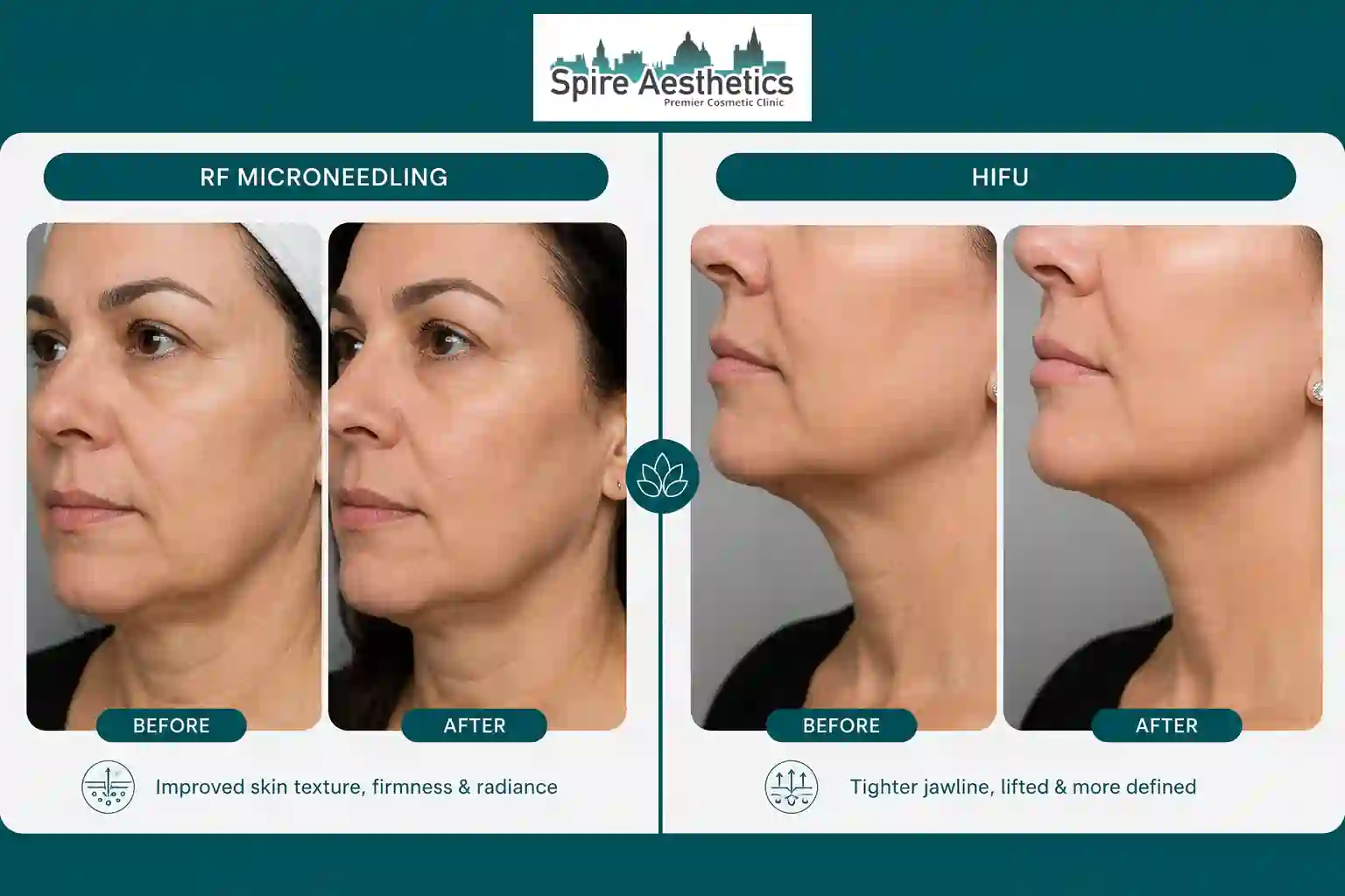 Can RF Microneedling and HIFU Be Combined Sheffield?