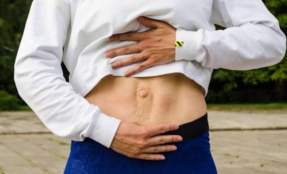When Could Diastasis Recti Be the Missing Piece of the Puzzle Sheffield?