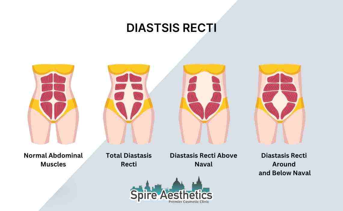 Is Non-Surgical Diastasis Recti Treatment Right for You? Common Concerns Answered Sheffield